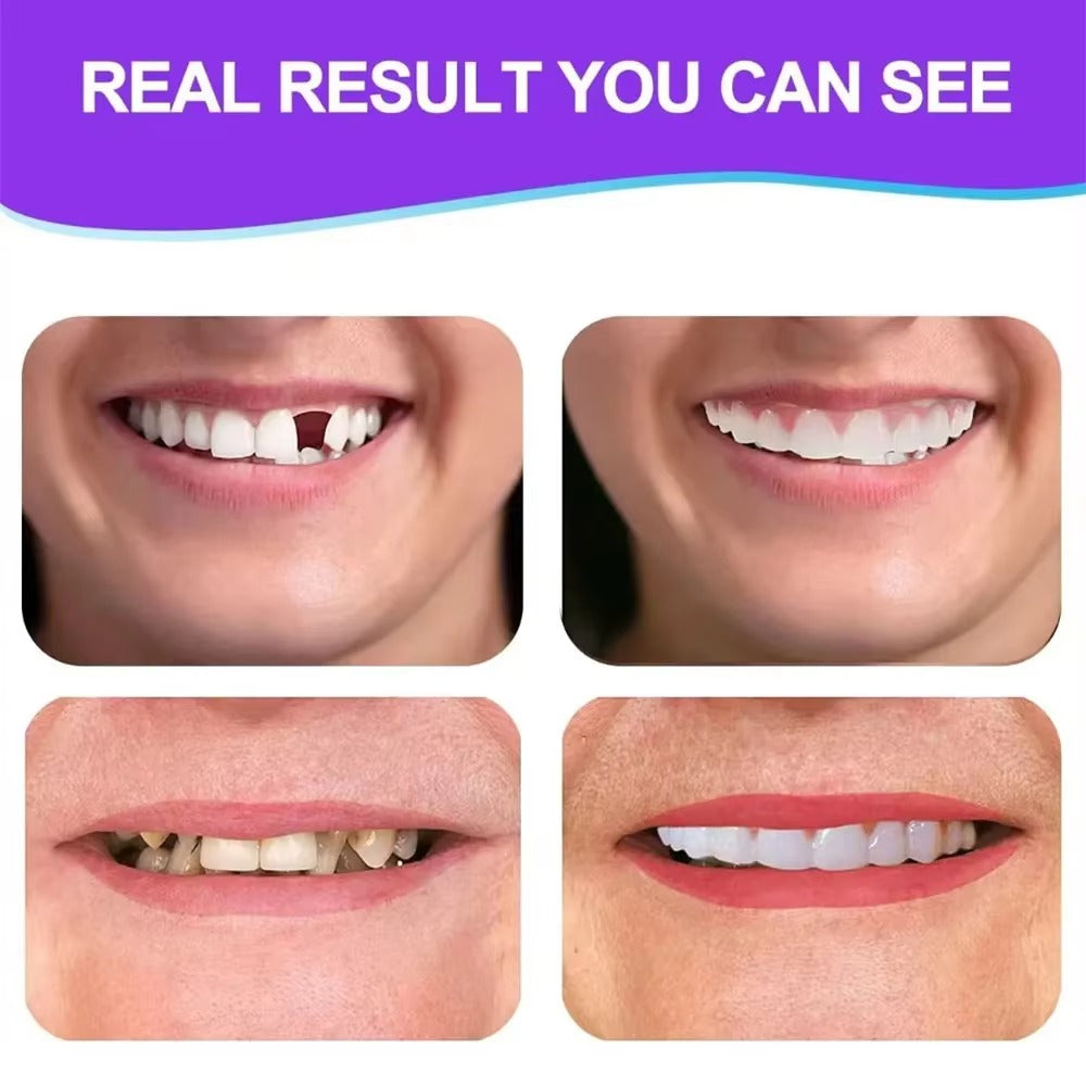 Κιτ χυτεύσιμης οδοντοστοιχίας FlexiSmile™