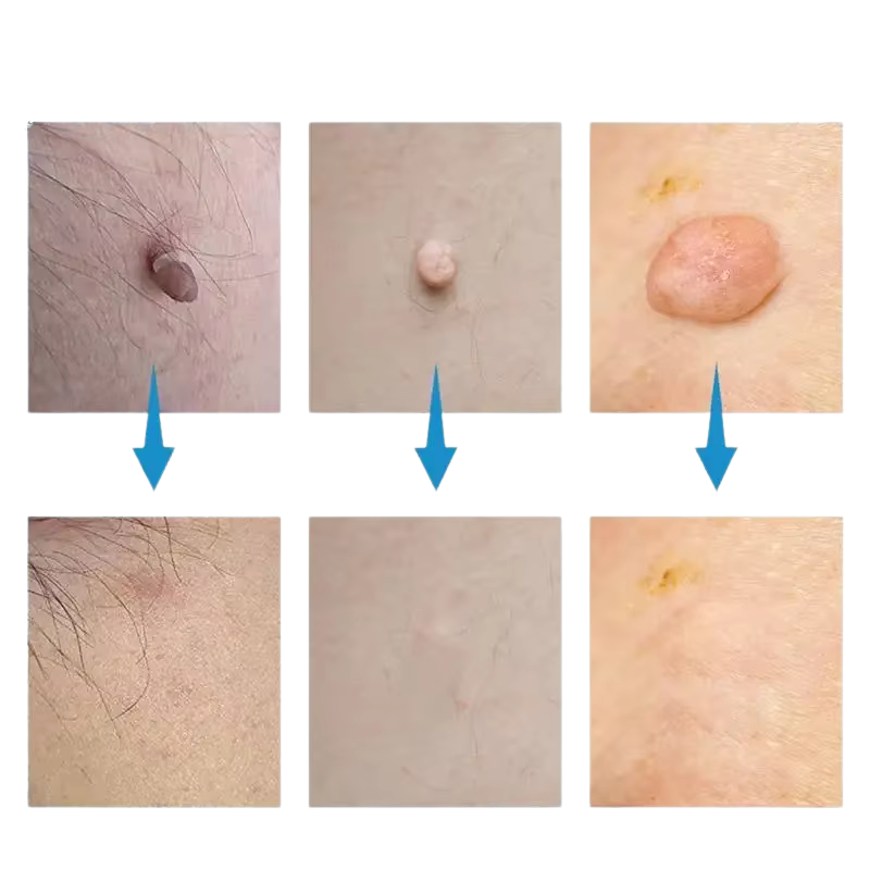 Κιτ αφαίρεσης κρεατοελιών SkinSilence™