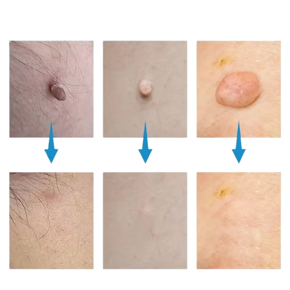 Κιτ αφαίρεσης κρεατοελιών SkinSilence™